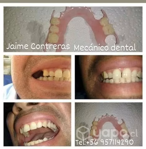 Prótesis dentales en laboratorio y a domicilio