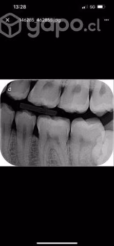 Extracciones dentales gratis Concepcion