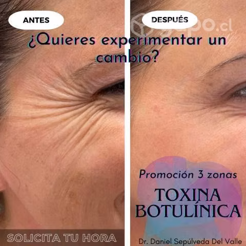 Botox 3 zonas