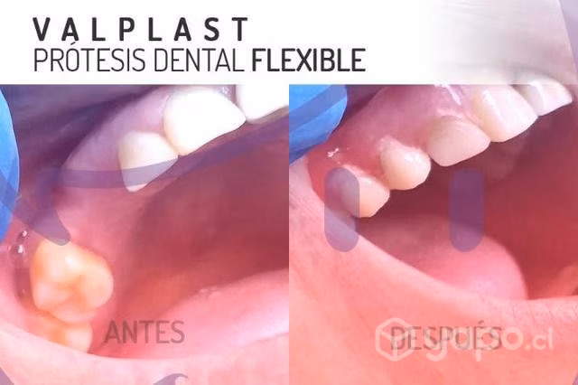 Prótesis dental