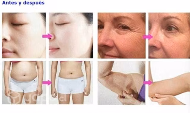 Equipo cavitación, belleza facial y corporal radio