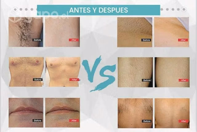 Máquina de depilación sistema láser diodo