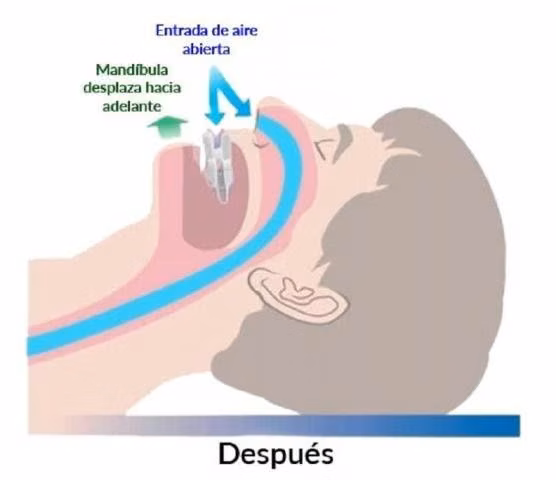 Placa Mandibular Anti-Ronquido - Antironquidos - Imagen 4