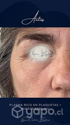 Plasma Rico en Plaquetas Rostro o Capilar Temuco