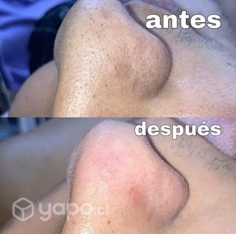 Limpiezas faciales y tratamientos