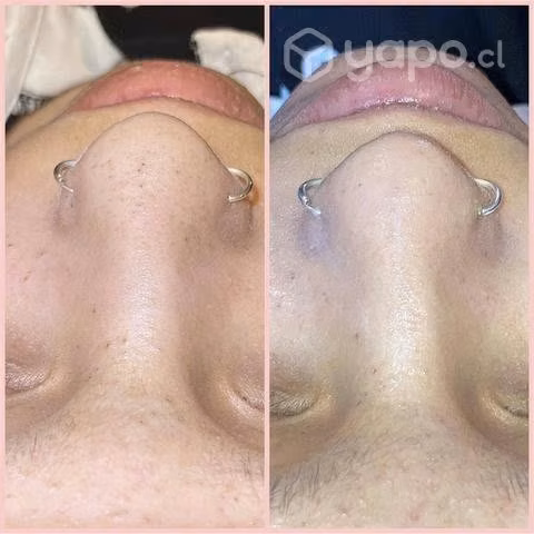Limpiezas faciales y tratamientos