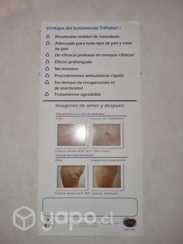 Radiofrecuencia tripollar - Imagen 3