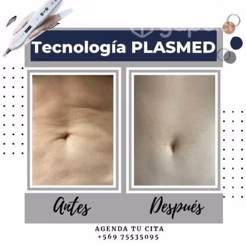 Elimina flacidez, estrías y celulitis