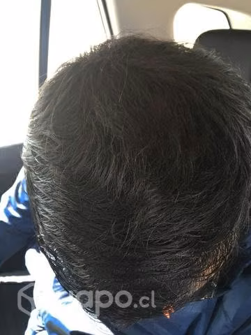 Nano Hair calvicie