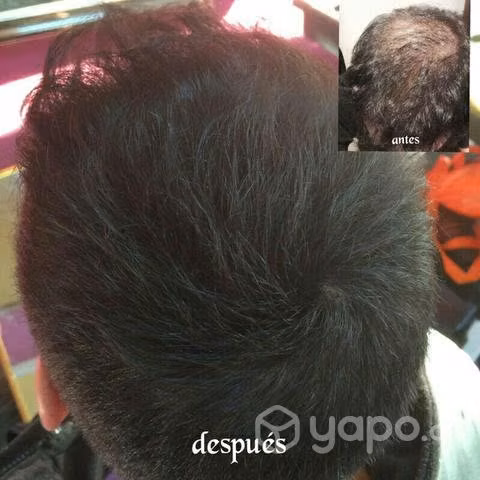 Nano Hair calvicie