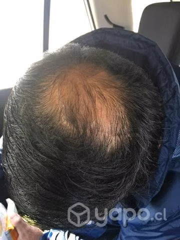 Nano Hair calvicie