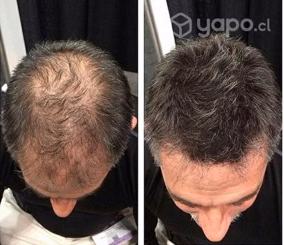 Nano Hair calvicie
