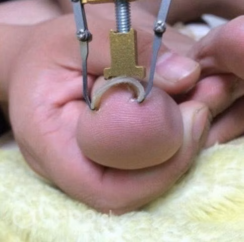 Herramienta Profesional Corrector Uñas Encarnadas