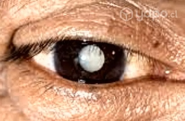 Lentes de contacto estéticos para ojo ciego