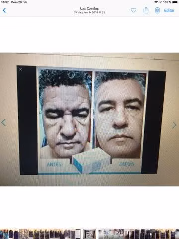 Elimina arrugas y bolsas de ojos tb cuello manos