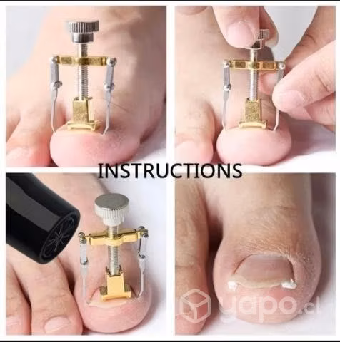 Dispositivo Para Corrección De Uñas Encarnadas