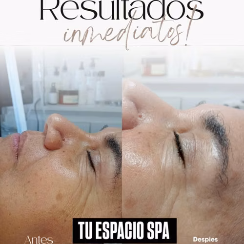 Tratamiento Faciales Limpieza Facial Profunda