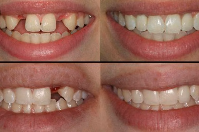 Placas dental