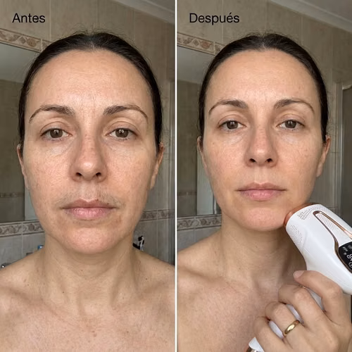 Depilación LASER IPL permanente
