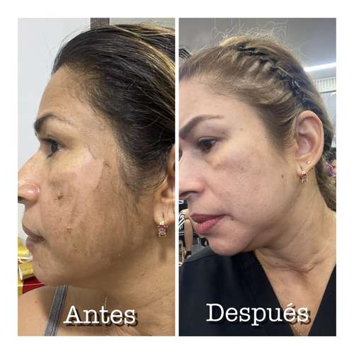 Tratamiento faciales específico 